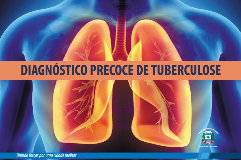 Prefeitura terá busca ativa de pacientes com tuberculose
